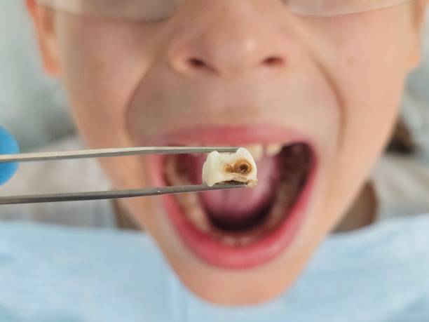Best Dentist for Tooth Abscess  in Fairmount, TN